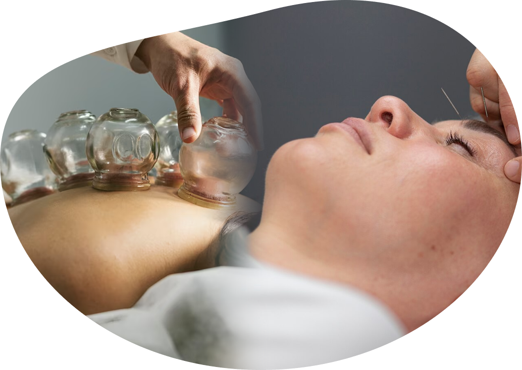 cupping therapy Mississauga