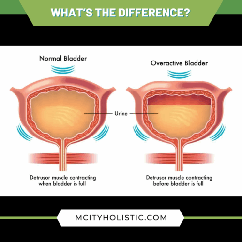 Difference between a normal bladder and an overactive bladder